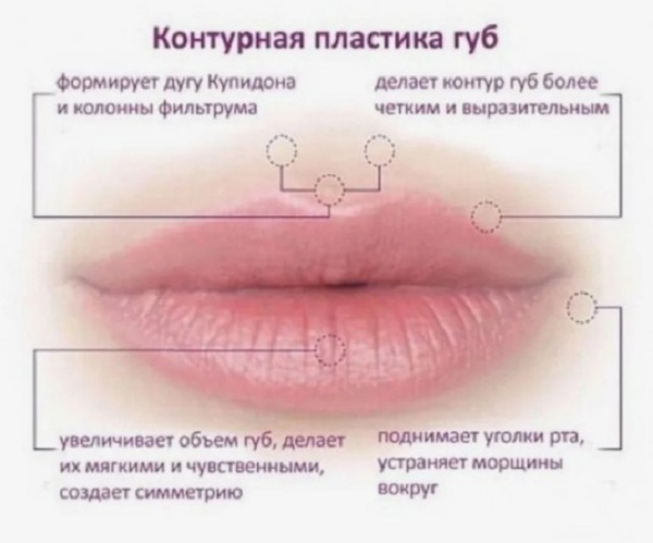 Плюсы и минусы контурной пластики губ: что нужно знать