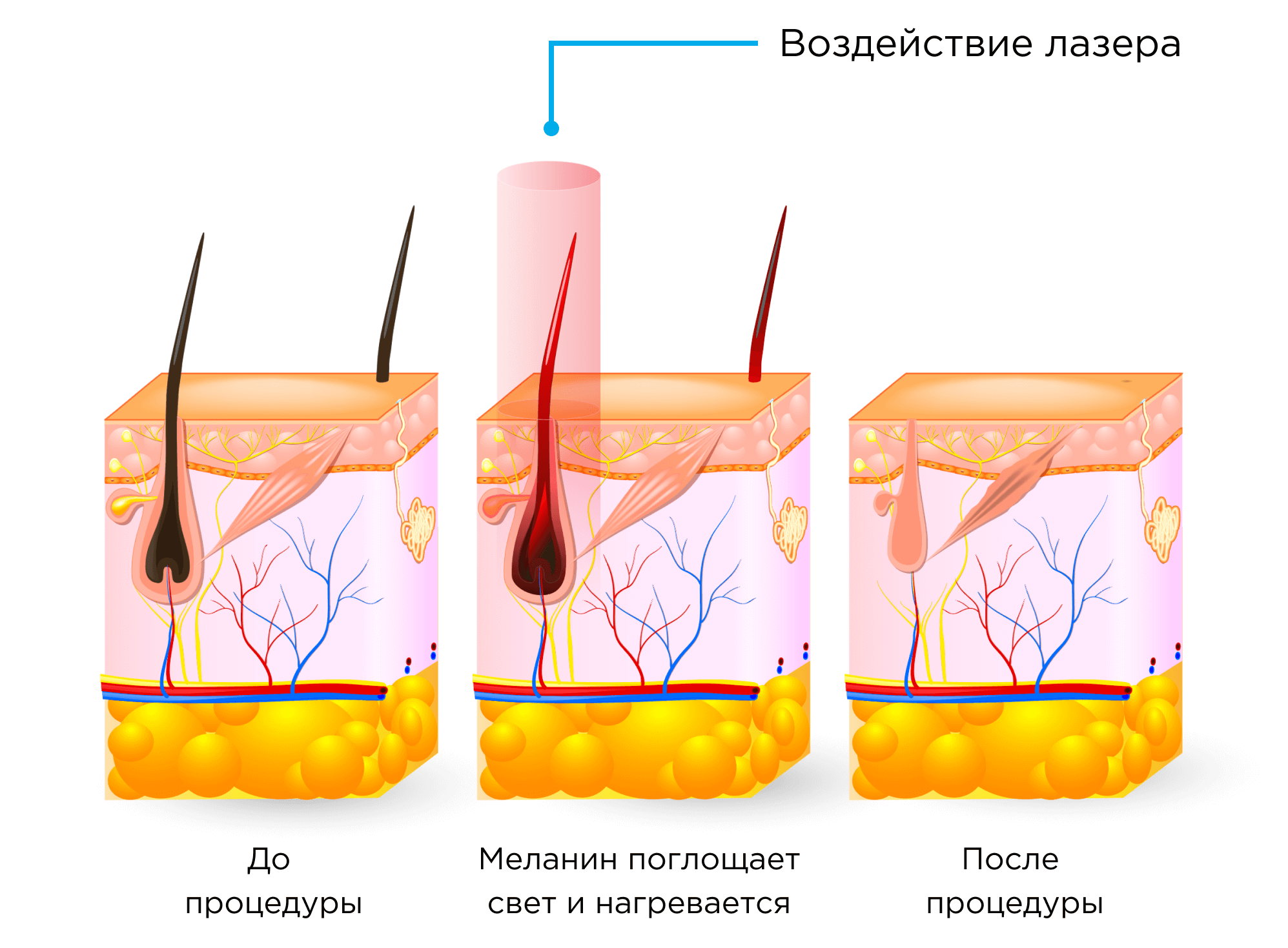 Лазерная эпиляция: типы лазеров, преимущества, особенности