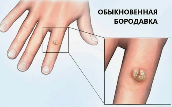 Бородавка: симптомы и лечение