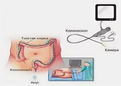 Колоноскопия: зачем делают, как готовиться и чего ожидать
